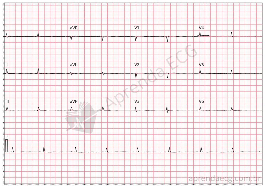 Eletrocardiograma com baixa voltagem do qrs