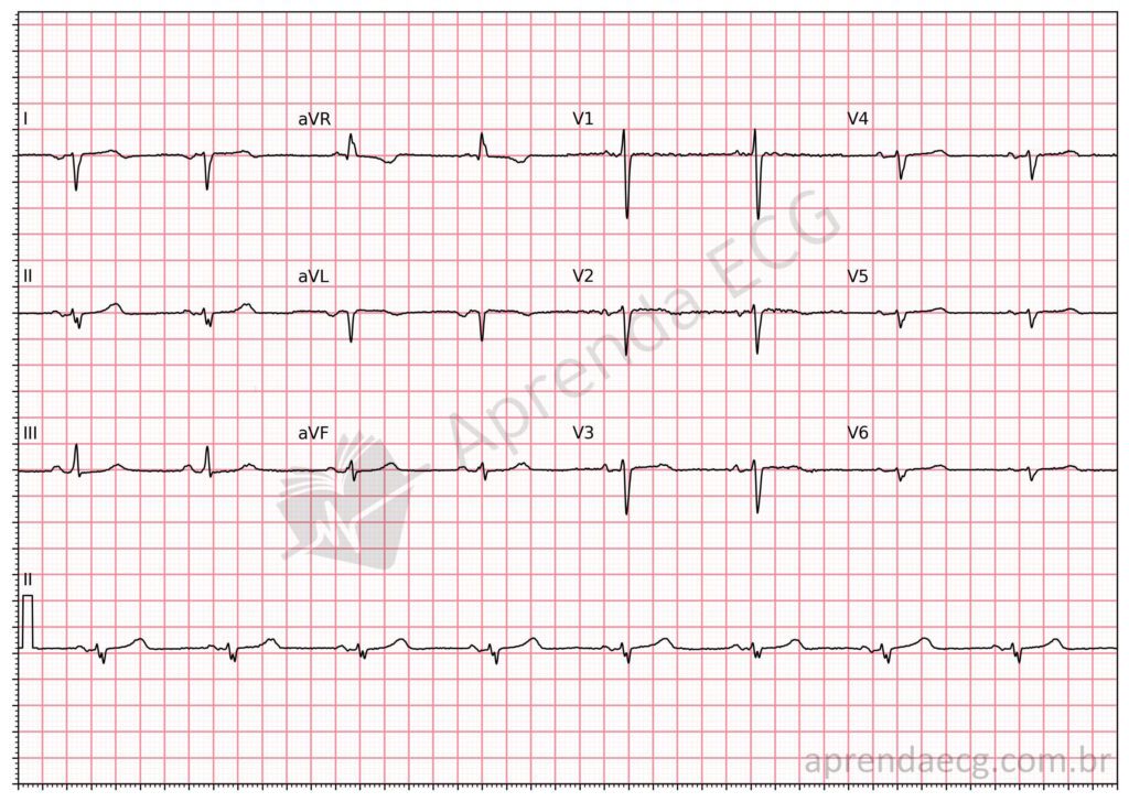 Eletrocardiograma com dextrocardia