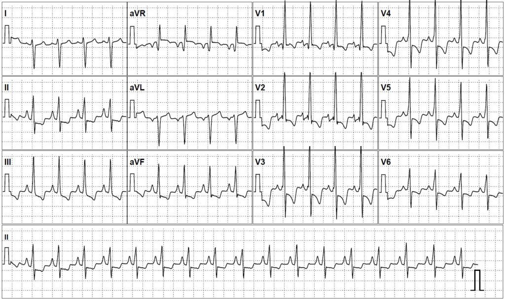Eletrocardiograma mostrando padrão qR em V1 com desvio de eixo para a direita
