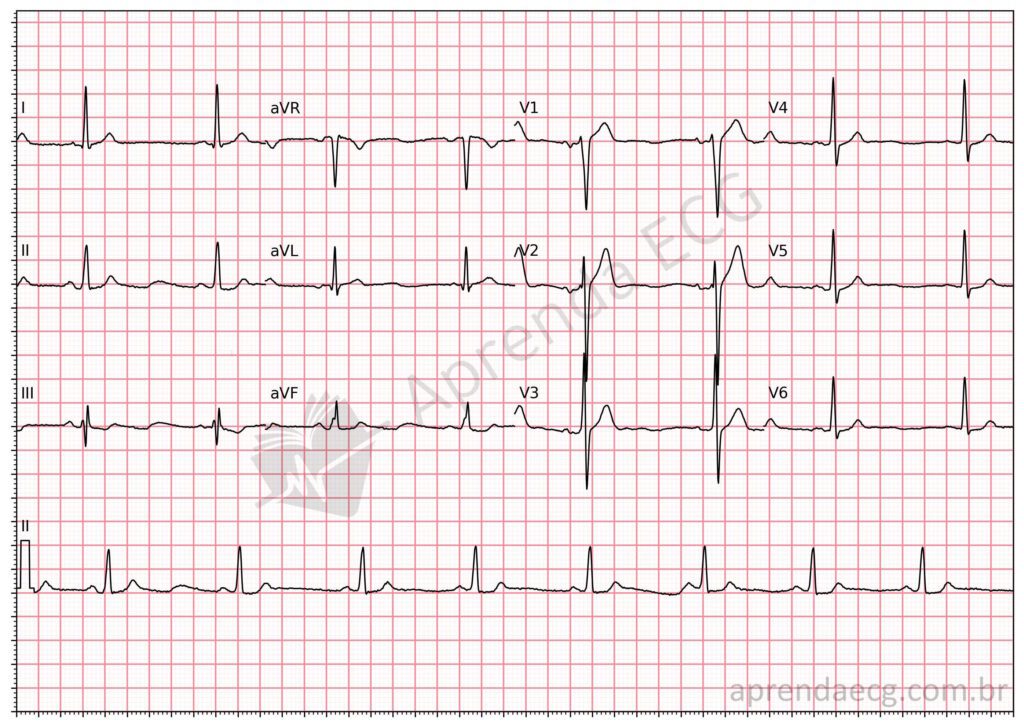 Eletrocardiograma na hipercalcemia