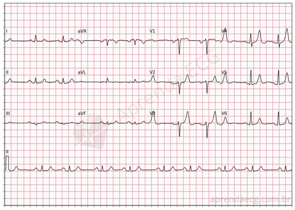 Eletrocardiograma de sobrecarga atrial esquerda pelo índice de Morris