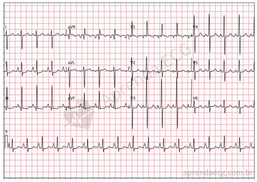 Eletrocardiograma com critérios para sobrecarga ventricular direita e sobrecarga atrial direita