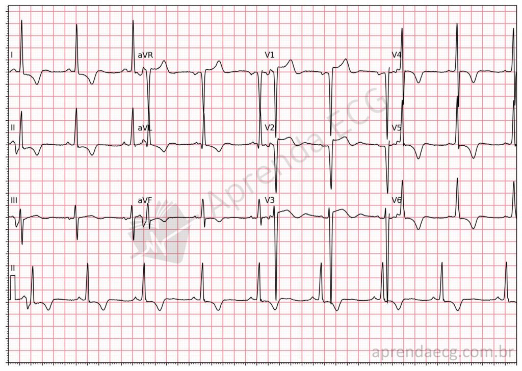 Eletrocardiograma com critérios de sobrecarga ventricular esquerda