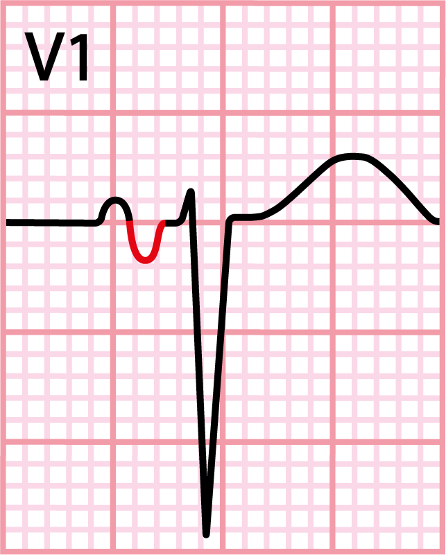 índice de Morris um sinal de sobrecarga atrial esquerda no eletrocardiograma