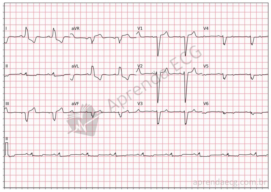 Eletrocardiograma mostrando bloqueio de ramo esquerdo com alterações do segmento ST sugestivas de oclusão coronária aguda