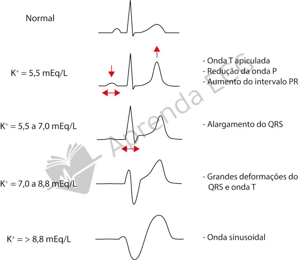 Alterações eletrocardiográficas na hipercalemia