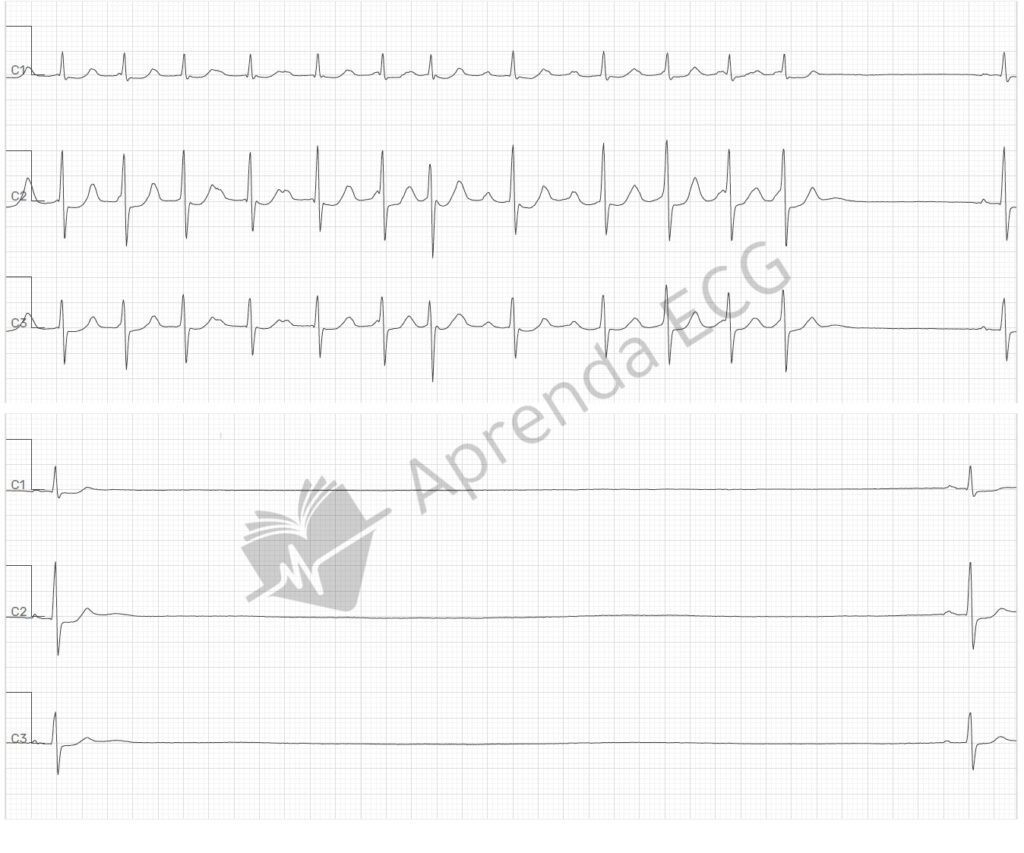 Síndrome bradicardia-taquicardia