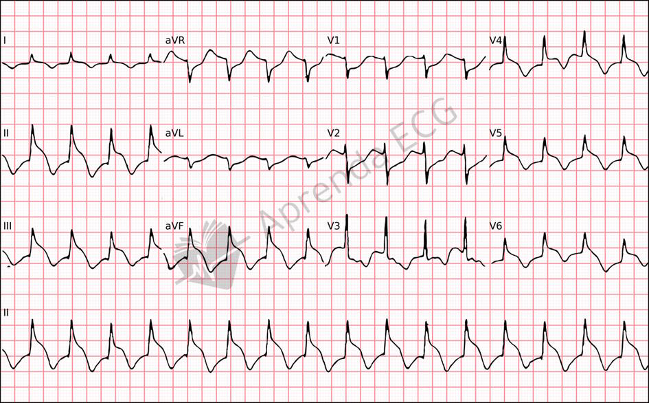 Eletrocardiograma com o sinal do capacete pontiagudo