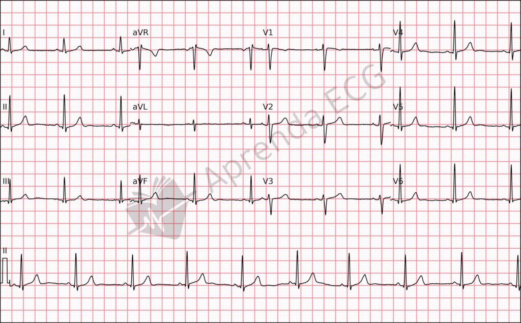 Eletrocardiograma com ritmo sinusal