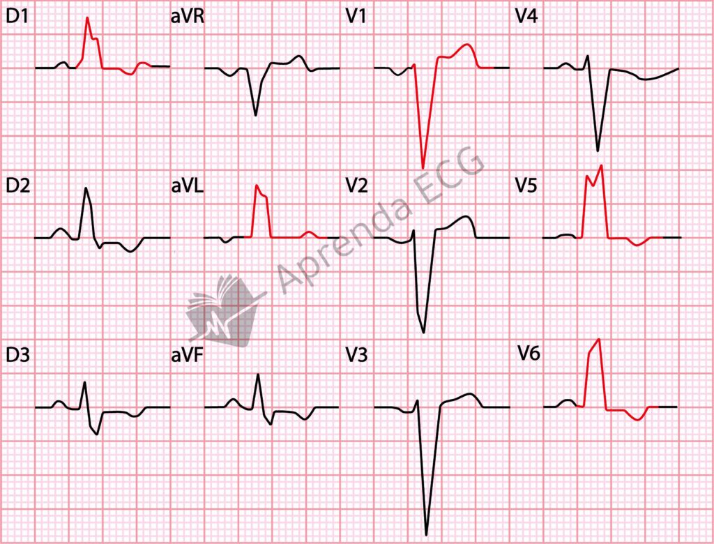 Bloqueio de ramo esquerdo