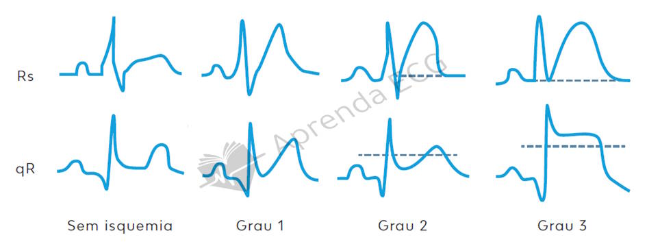graus de isquemia no ecg