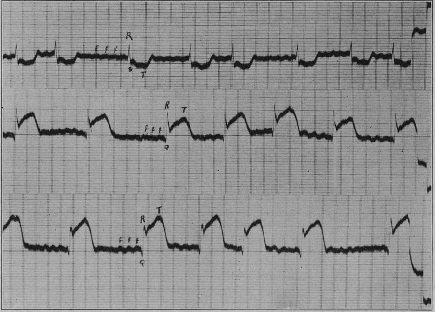 Supradesnivelamento do segmento do ST demonstrado por Pardee em 1920 após uma oclusão coronária aguda.