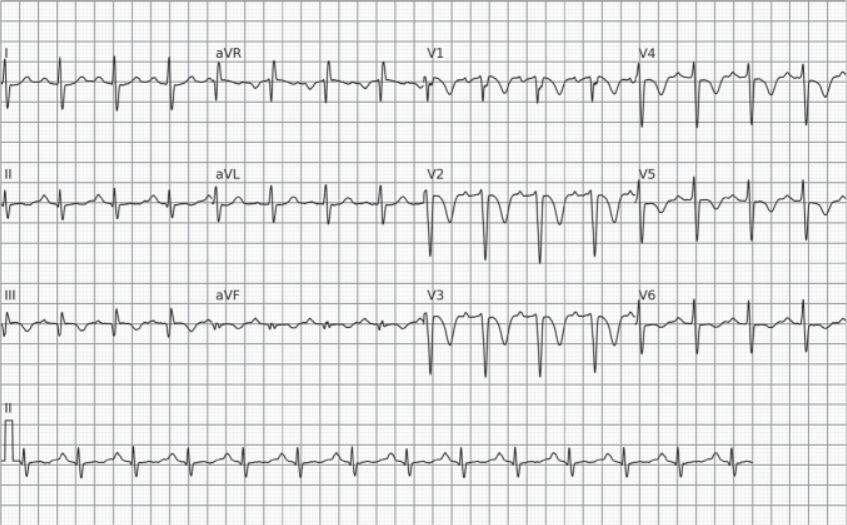 Eletrocardiograma mostrando padrão S1Q3T3 e taquicardia sinusal