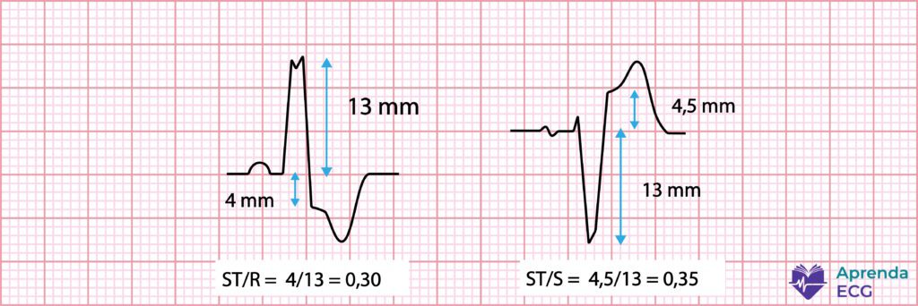 Critério de Sgarbossa Modificado